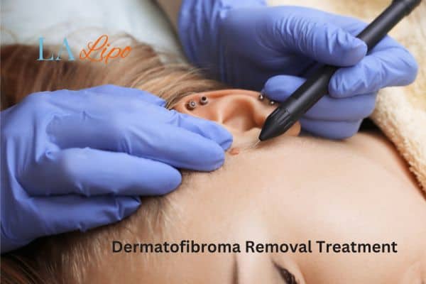 Dermatofibroma Removal Treatment North Acton