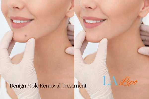 woman's before and after mole removal North Acton results