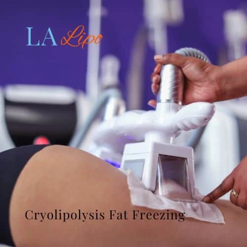 fat freezing - Cryolipolysis North Acton