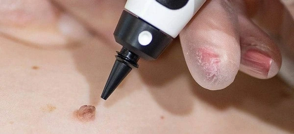 skin tag removal using cryopen North Acton