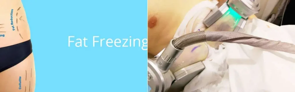 Fat freezing North Acton on multiple areas of the body