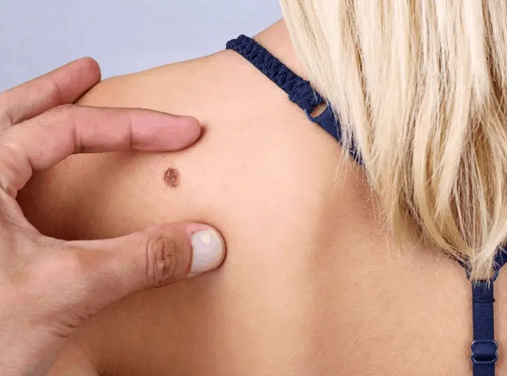 woman having mole removal North Acton consultation before treatment.