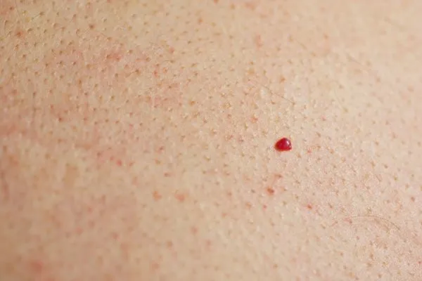 close up of a cherry angioma North Acton