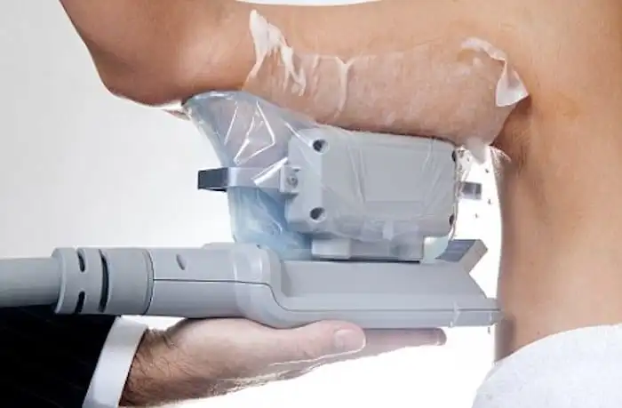 Picture of fat freezing North Acton on the upper arms.