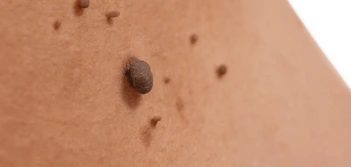 image of a skin tag North Acton