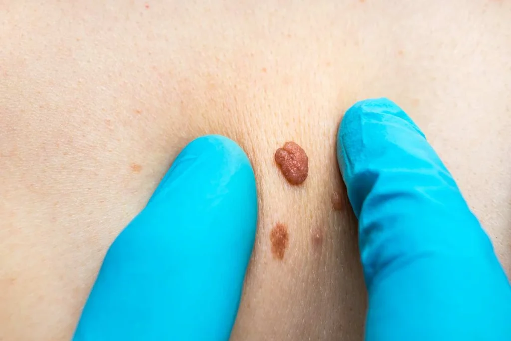 Consultant examining a skin tag North Acton