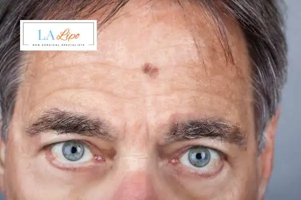 Solar Lentigo Removal North Acton image of man with mark on his forehead
