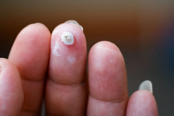 wart on person finger - cryotherapy to treat from LA LIPO North Acton
