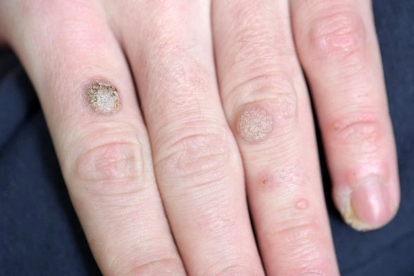 photo of warts on person hand - see wart removal North Acton from LA LIPO
