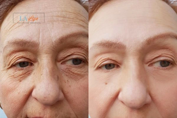 The powerful benefits of Morpheus8 Treatment North Acton - Call Our team today!