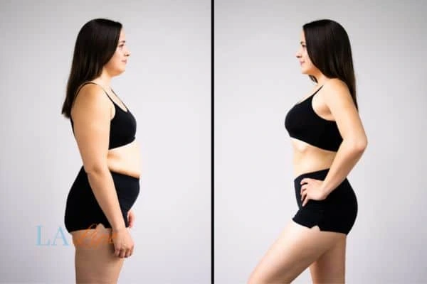 Picture of womans before and after using LA-EMS body sculpting to improve her core strength North Acton
