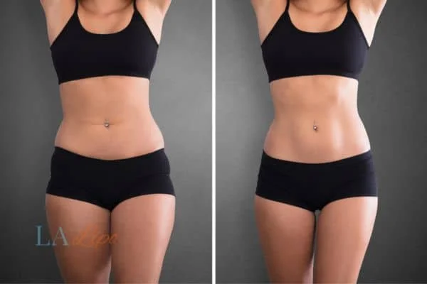 before and after results of non-surgical treatment to help a woman's body image and mental health North Acton