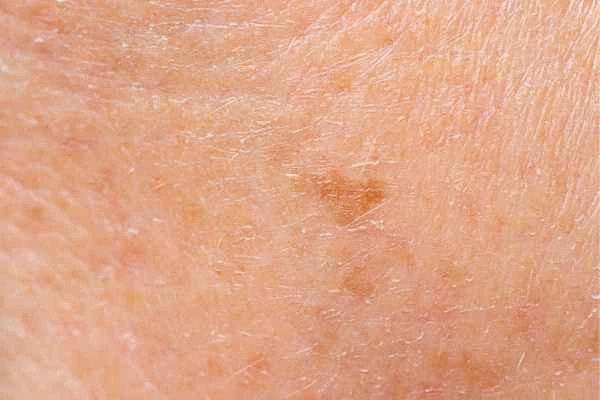 close up picture of age spots North Acton